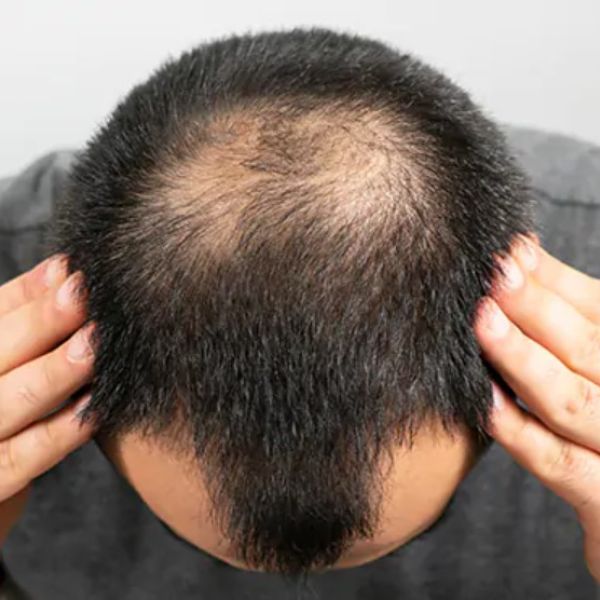 foto van dunner wordend haar bij mannen - de beste kapsels voor mannen met dunner wordend haar